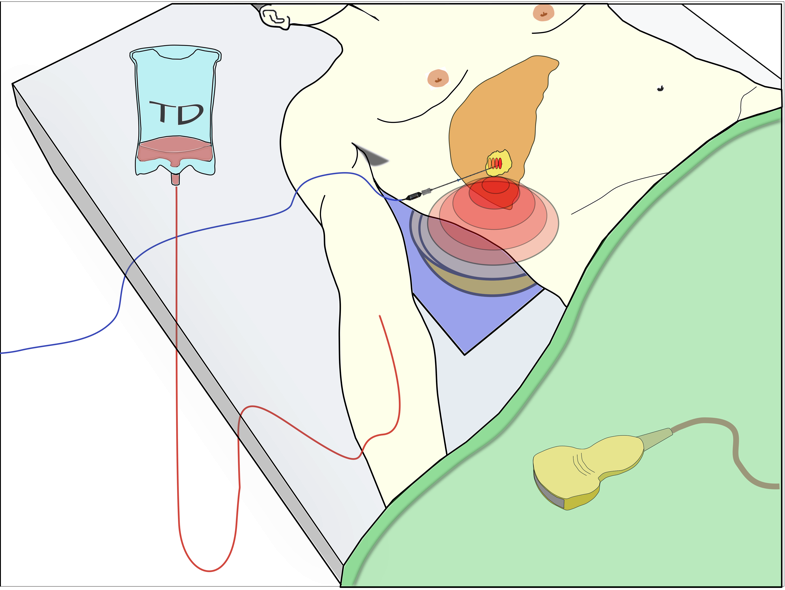 Diagram showing intravenous dose of Thermodox being given to patient lying on hospital bed, with target tumour shown as being heated using ultrasound