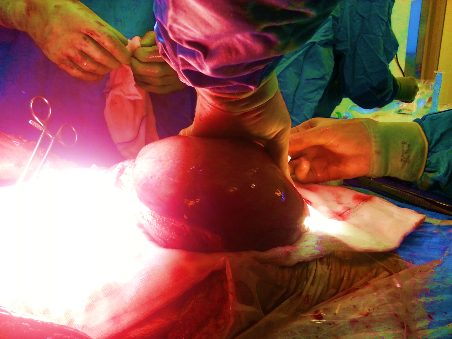 Liver transplantation operation in process
