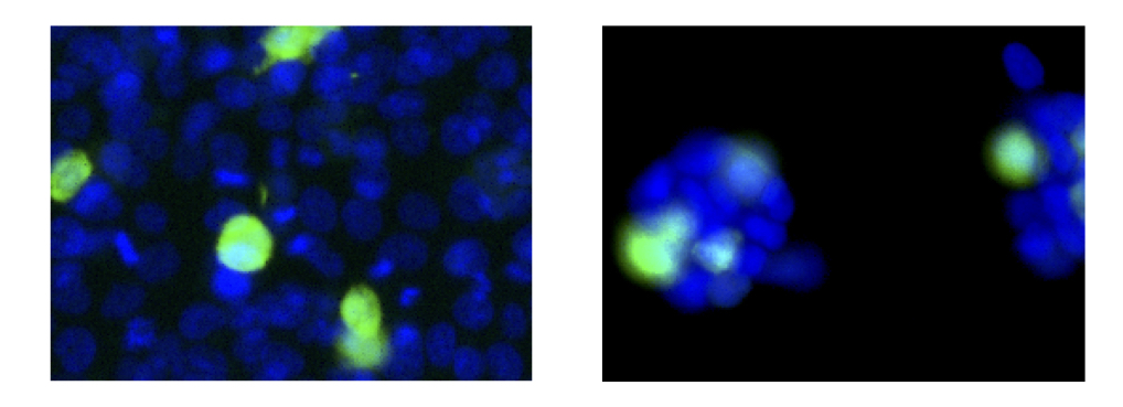 Colon cancer cells shown before and after the perturbation of a gene showing levels of genes reduced by experimental techniques
