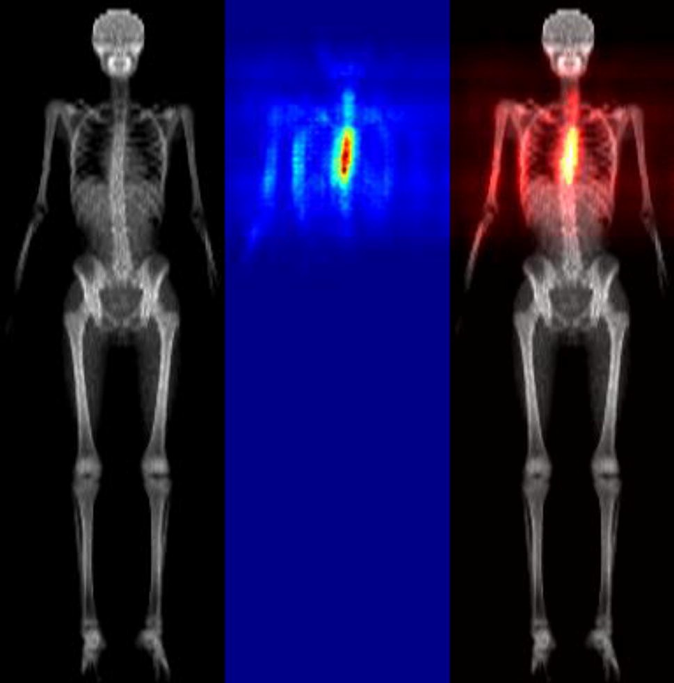 Heatmaps produced automatically that indicate the region of the total body scan that contributed to the decision that scoliosis was present