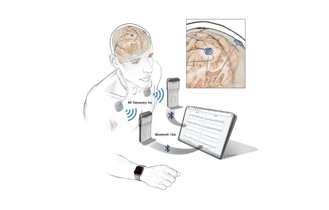 Open-source technology platforms will support a new generation of neurostimulation devices that not only provide stimulation to the brain but also sense, record, and stream brain activity.