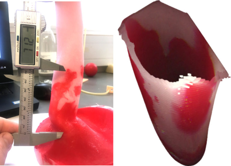I-driven 3D reconstruction of Barrett’s oesophagus