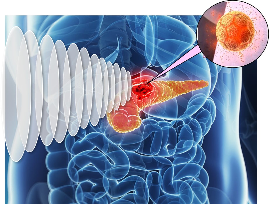 Pandox ultrasound for cancer